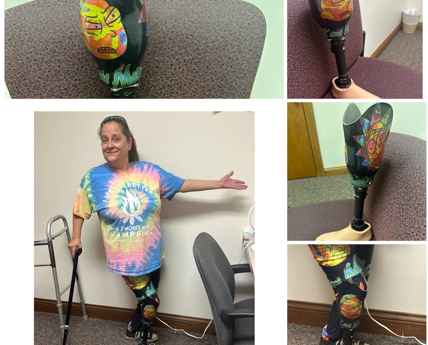 Patient Thrilled with New Prosthesis – Custom Lamination!